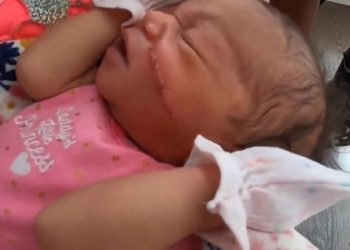 Bebê tem o rosto cortado durante cesárea de emergência