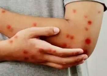 Espírito Santo registra 441 casos de febre do Oropouche e oito de mpox