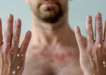 Alerta em ES: Casos de Mpox Disparam e Superam Números de 2023
