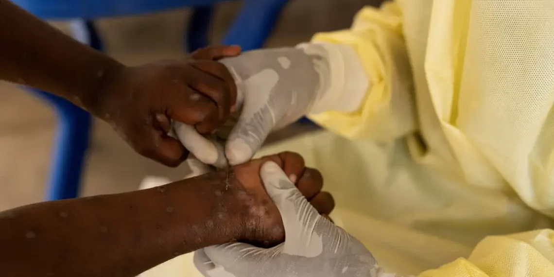 Saúde confirma primeiro caso de nova cepa de mpox no Brasil