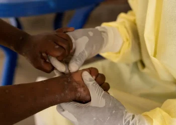 Saúde confirma primeiro caso de nova cepa de mpox no Brasil