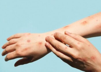 Mpox: Espírito Santo chega a quatro casos confirmados em 2026